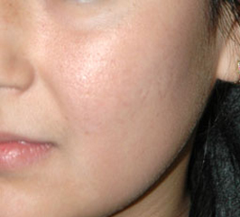 FRAXEL LASER RESURFACING - Patient 2 - After